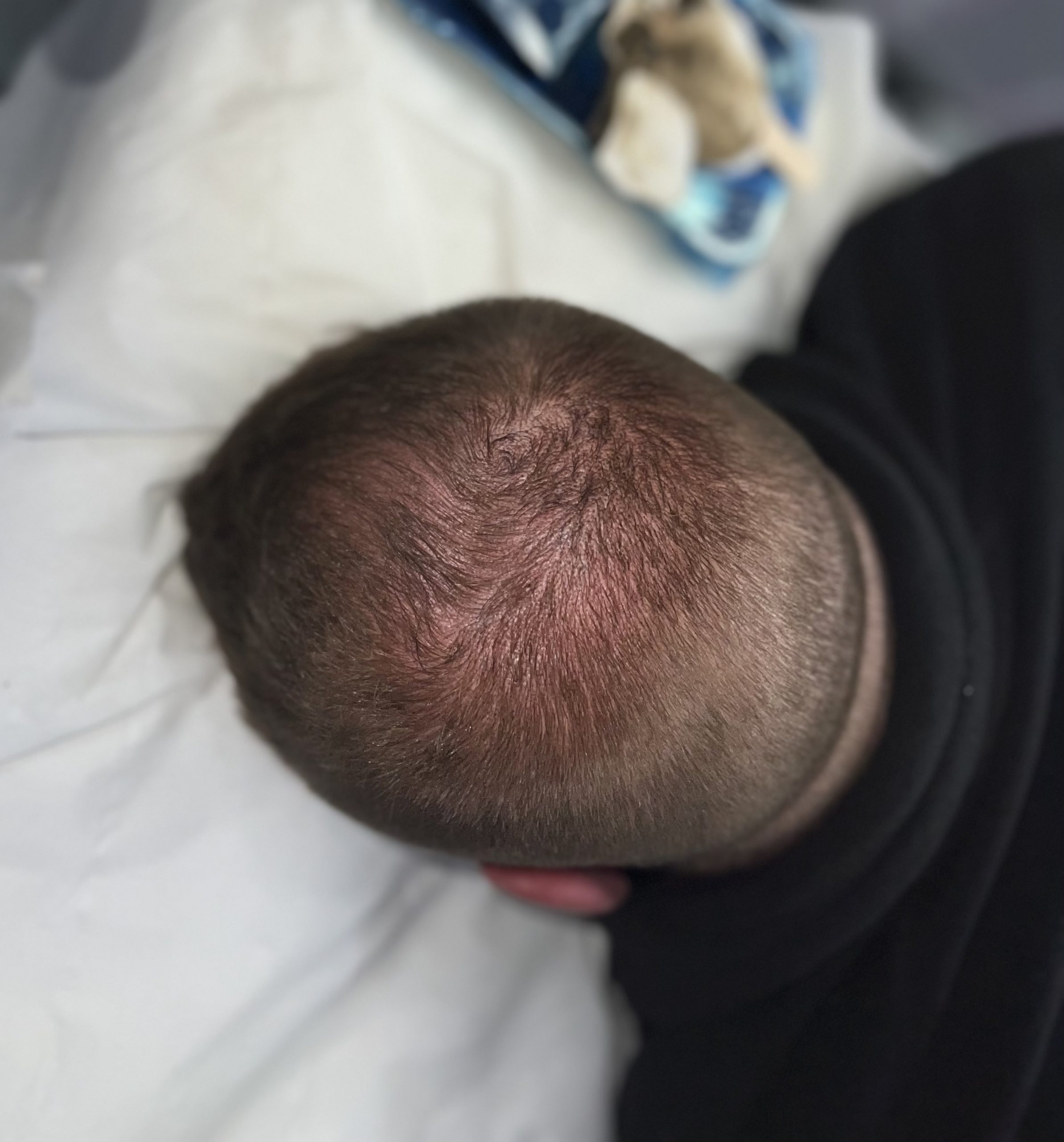 scalp densification