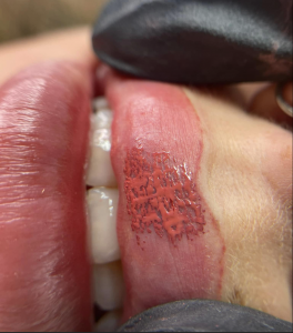 Close-up of lips with pigment during lip tinting procedure.