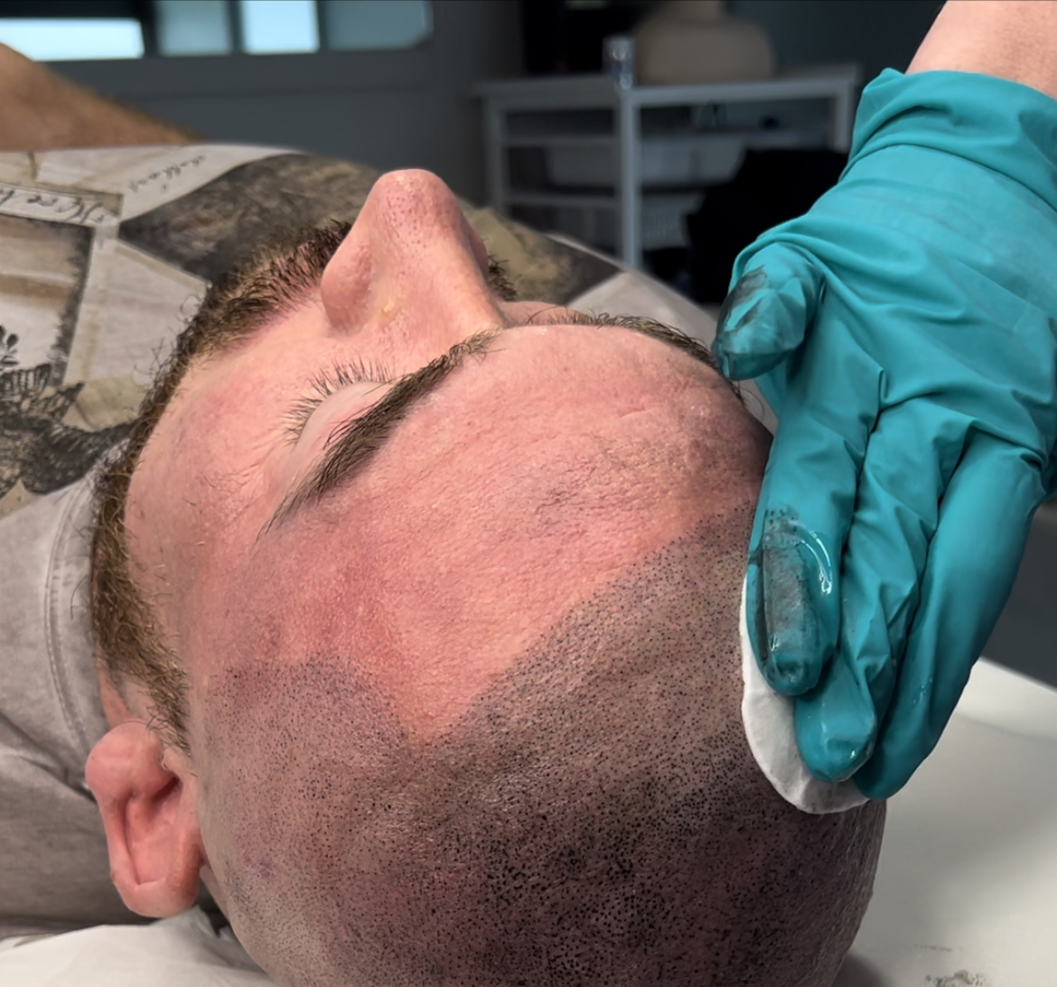 Scalp Micropigmentation