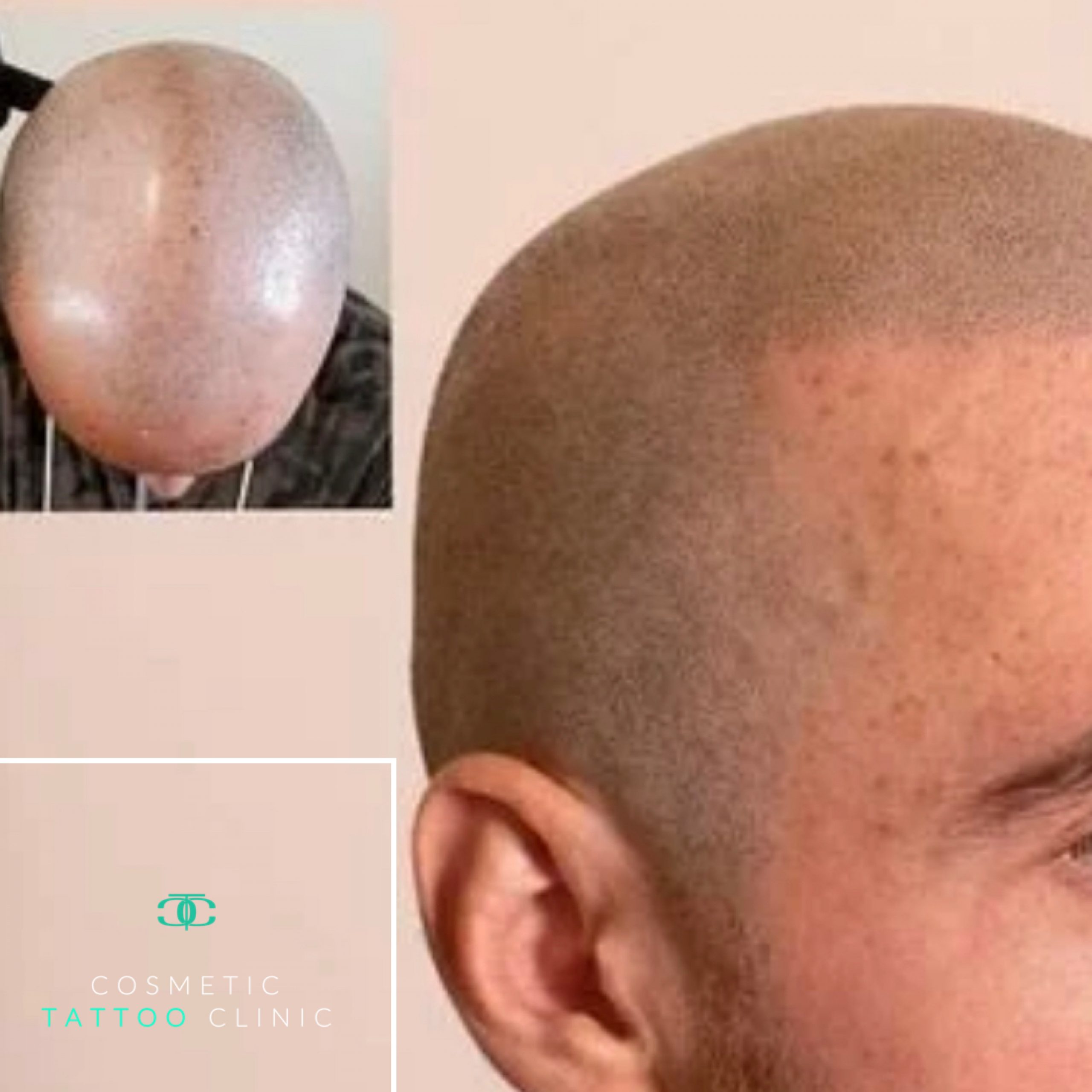 Scalp Micropigmentation