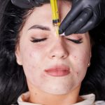 Close-up of female client with acne receiving polynucleotide treatment at Cosmetic Tattoo Clinic.