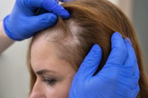 Female client suffering from hair thinning.