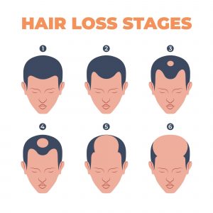 An infographic showing the male hair loss stages.