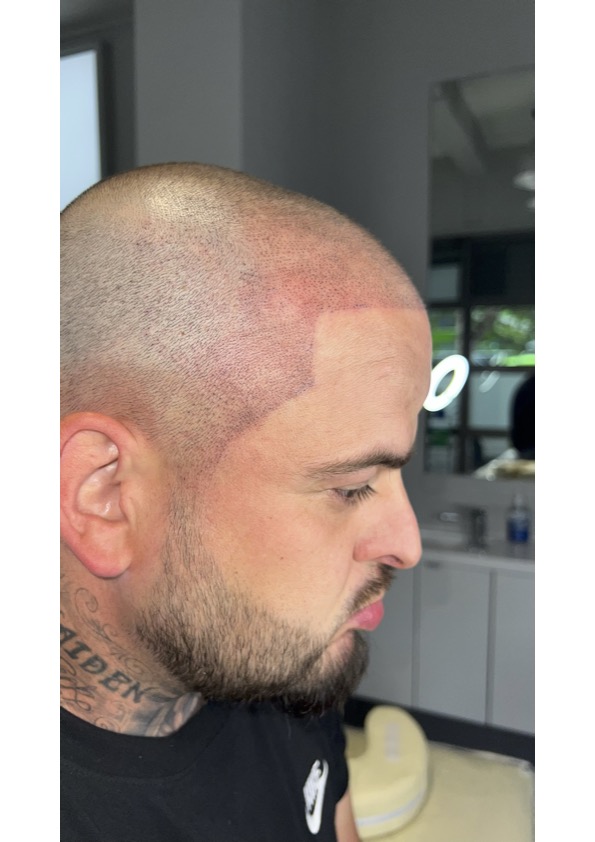 Scalp Micropigmentation