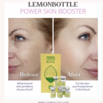 Image of a woman before and after Lemon Bottle treatment.