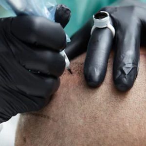 Scalp Micropigmentation demonstration on a male client.